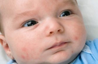 pourquoi un nouveau-né a-t-il de l'acné sur le visage