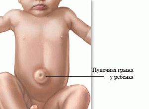 Symptoms of umbilical hernia in infants