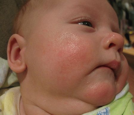المكورات العنقودية الذهبية في أعراض الرضع