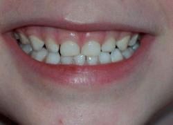 waarom knarst het kind zijn tanden