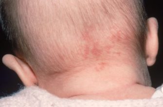 hemangioma ở phía sau đầu ở trẻ sơ sinh