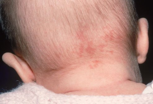 ورم وعائي في الجزء الخلفي من الرأس عند طفل حديث الولادة