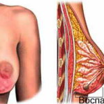 Symptomen van mastitis