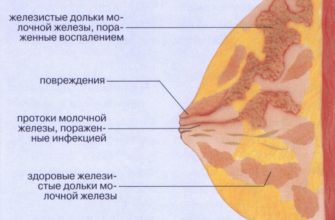laktostasis payudara