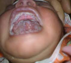 it is a strong thrush in the mouth of a newborn baby