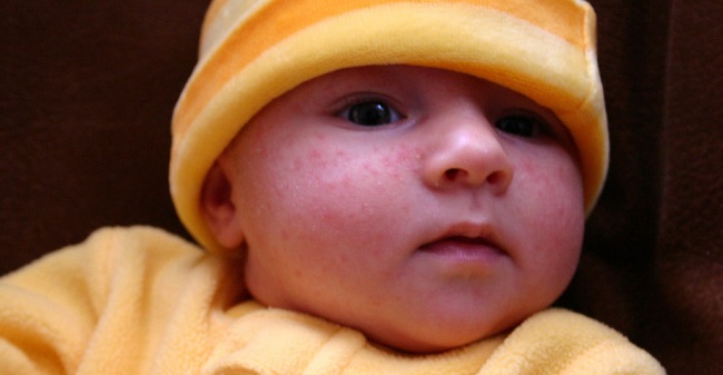 Mythes sur les nouveau-nés atteints d'acné