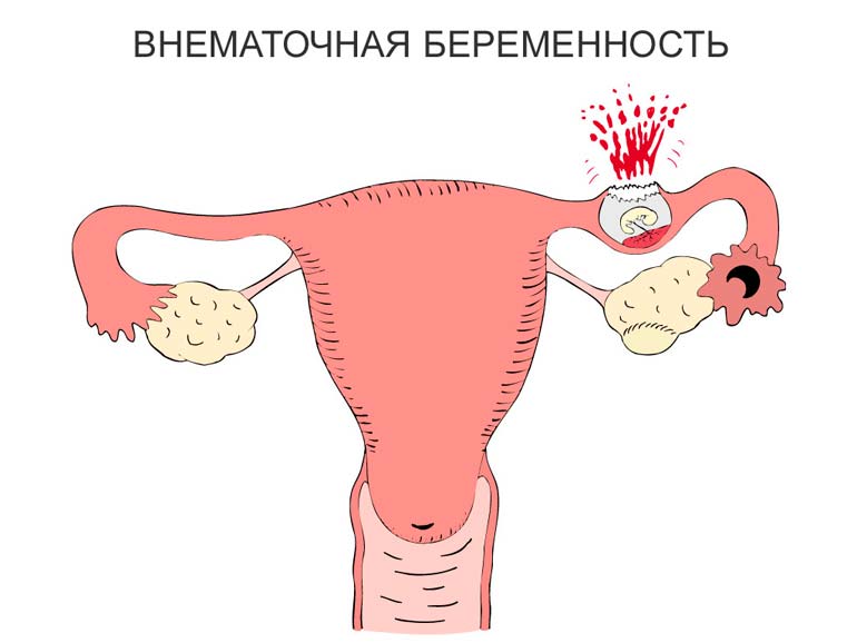 Ektopiás terhesség