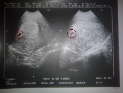 ultrasound scan in the sixth week of pregnancy