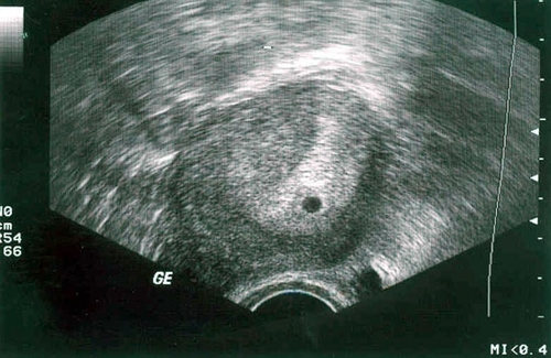 ultra-som por 2 semanas de gravidez