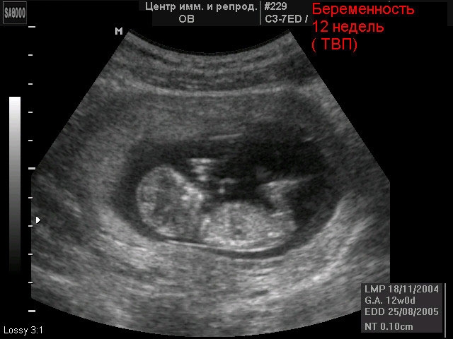 Ultra-som do feto com 12 semanas de gestação