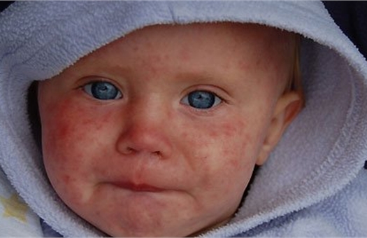 Measles in a child