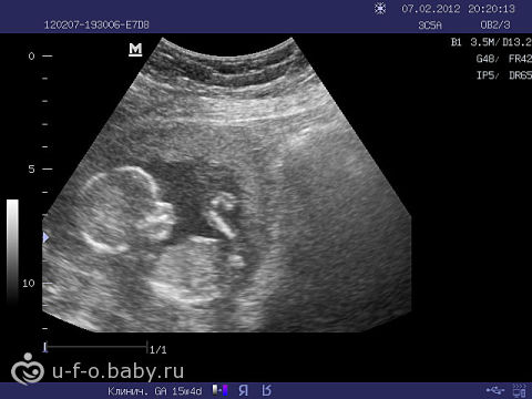 ultrazvuk 15 týdnů