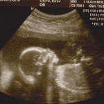 ultrazvuk 21 týdnů