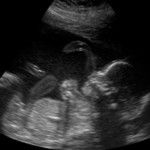 ultrasound foto
