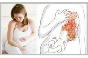 иззјога-при-беременности