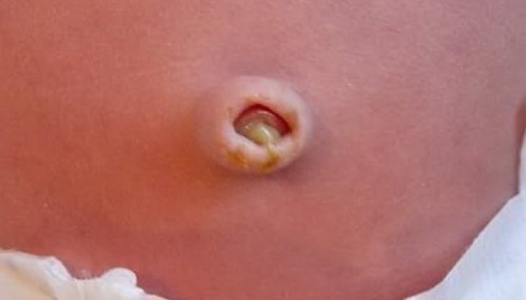 the navel in the newborn becomes wet