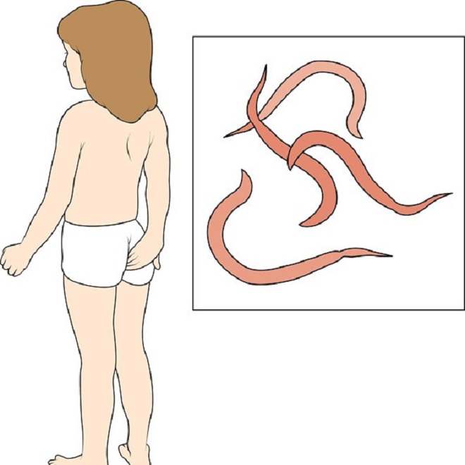 pinworms in a child